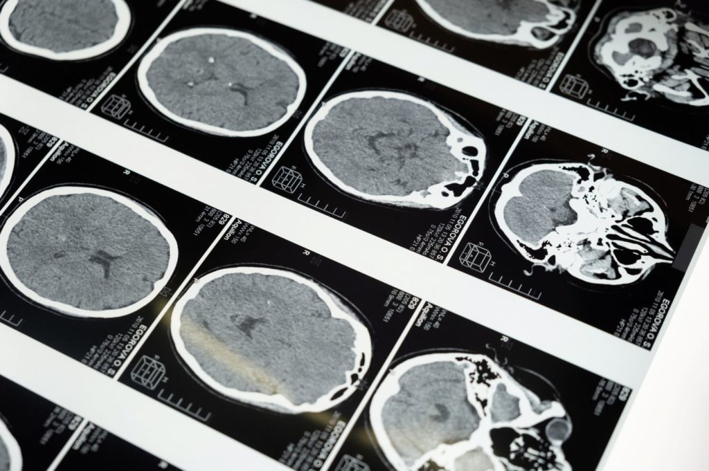 Alzhimers Resources: Facts and Figures