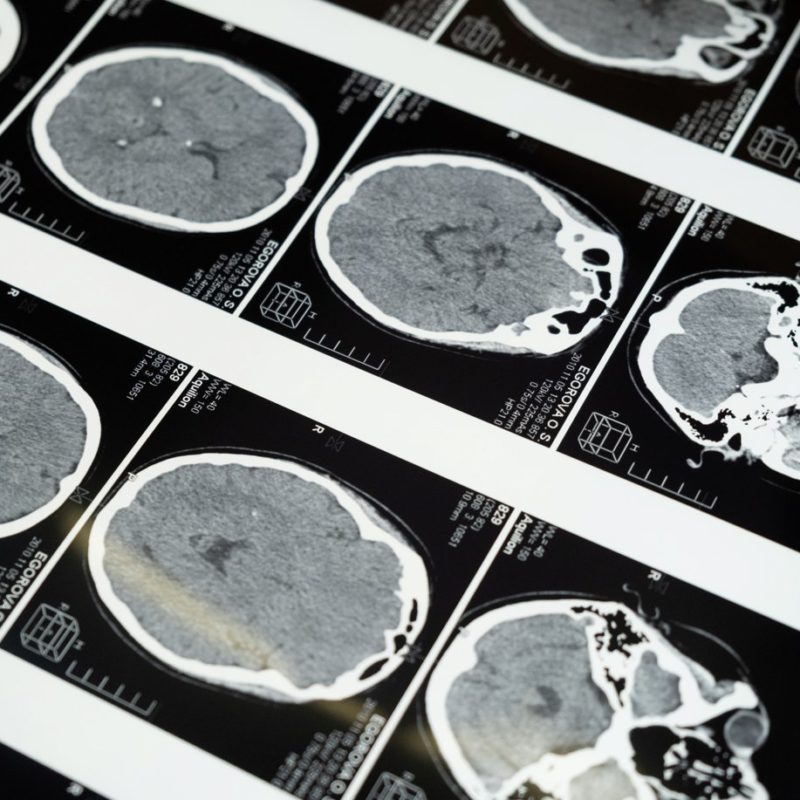 Alzhimers Resources: Facts and Figures